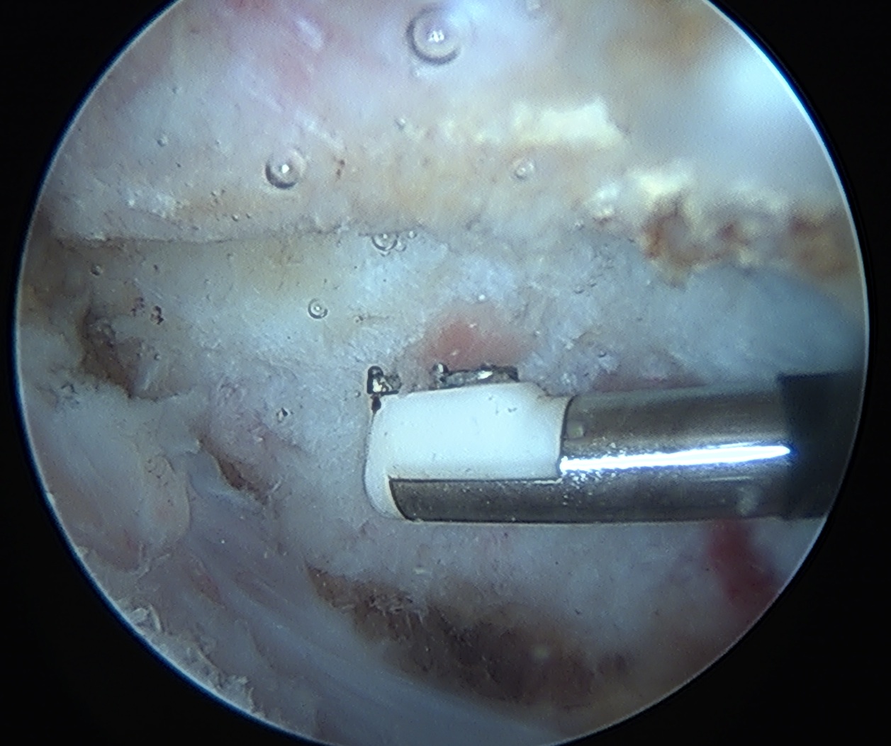 Os Acromiale Arthroscopic